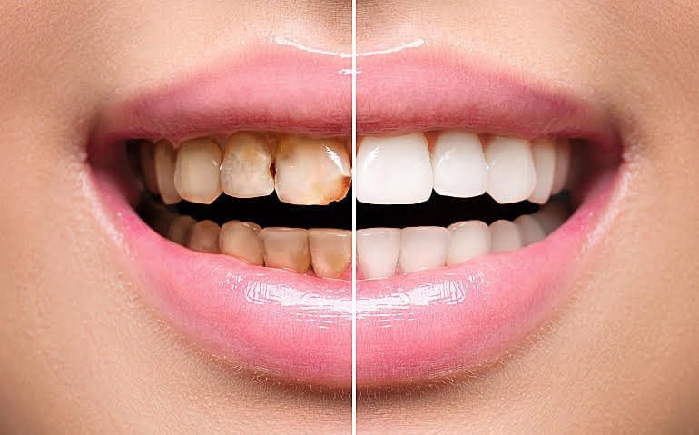 Dental Crown Treatments