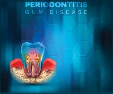 Periodontitis - gum disease