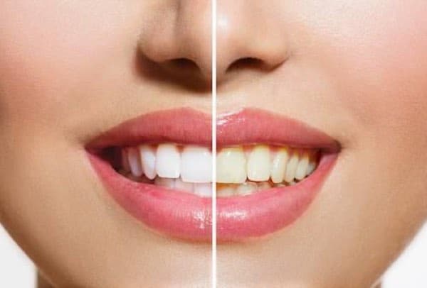 KoR teeth whitening tulsa area oklahoma