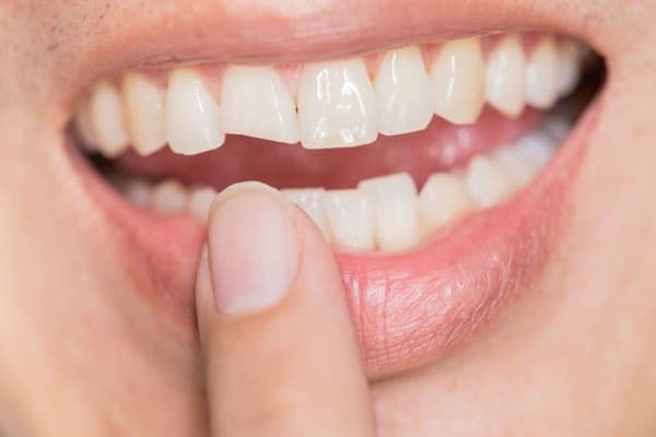 chipped tooth repair tulsa oklahoma