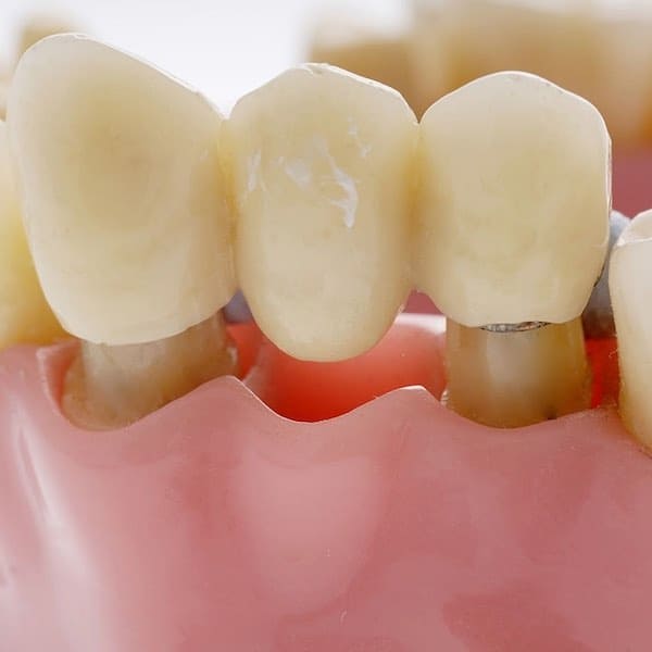 dental bridges tulsa oklahoma
