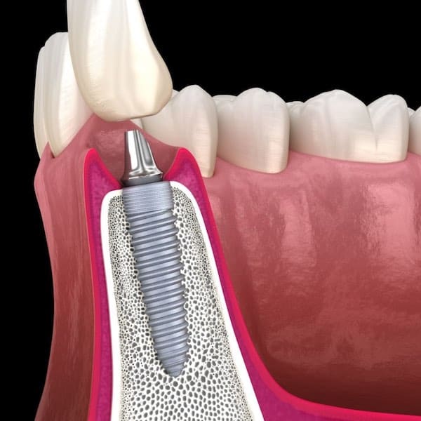 dental implant tulsa ok