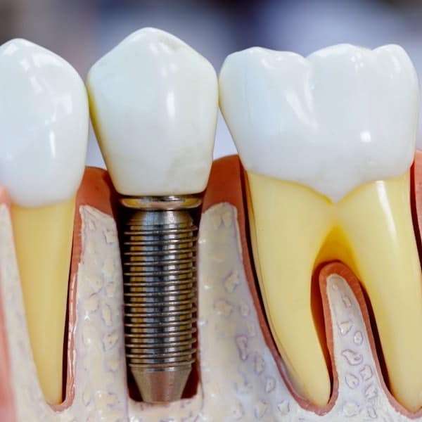 dental implant tulsa oklahoma
