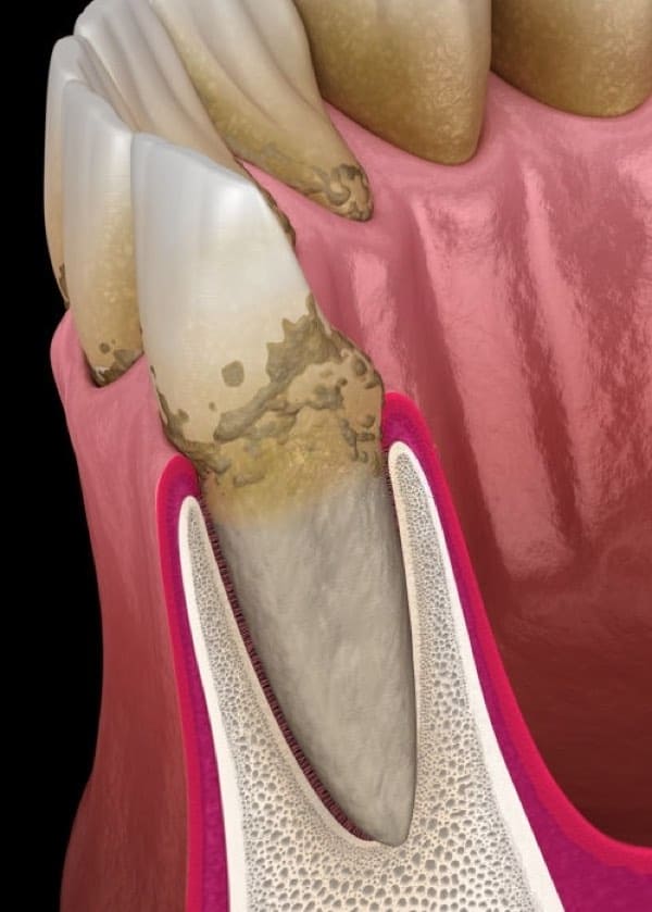 periodontal disease tulsa oklahoma