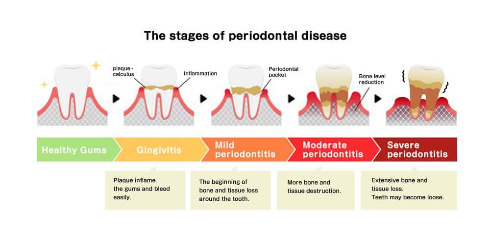 stages of periodontis tulsa oklahoma