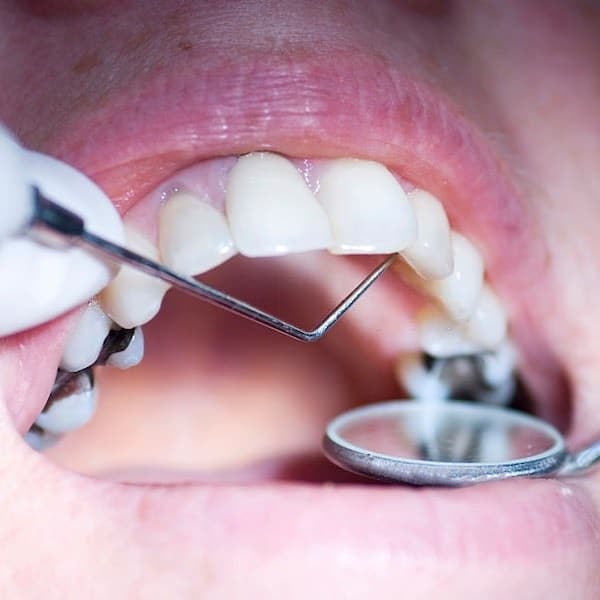 what are tulsa dental sealants