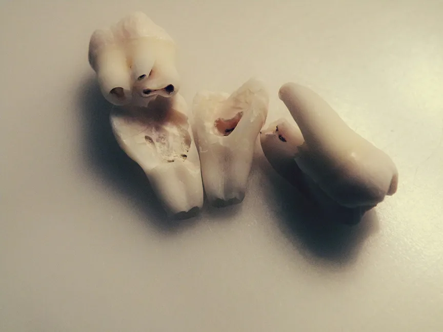What to Do When You Have a Knocked Out Tooth: Emergency Steps to Save Your Smile