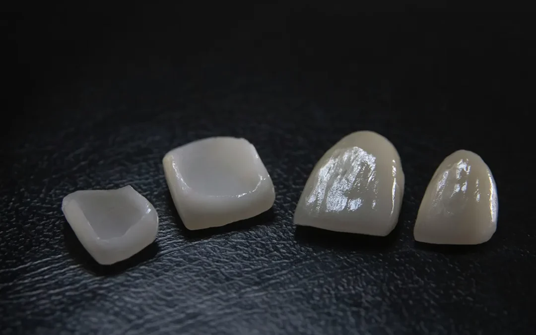 How Much Do Veneers Cost? A Complete Pricing Guide