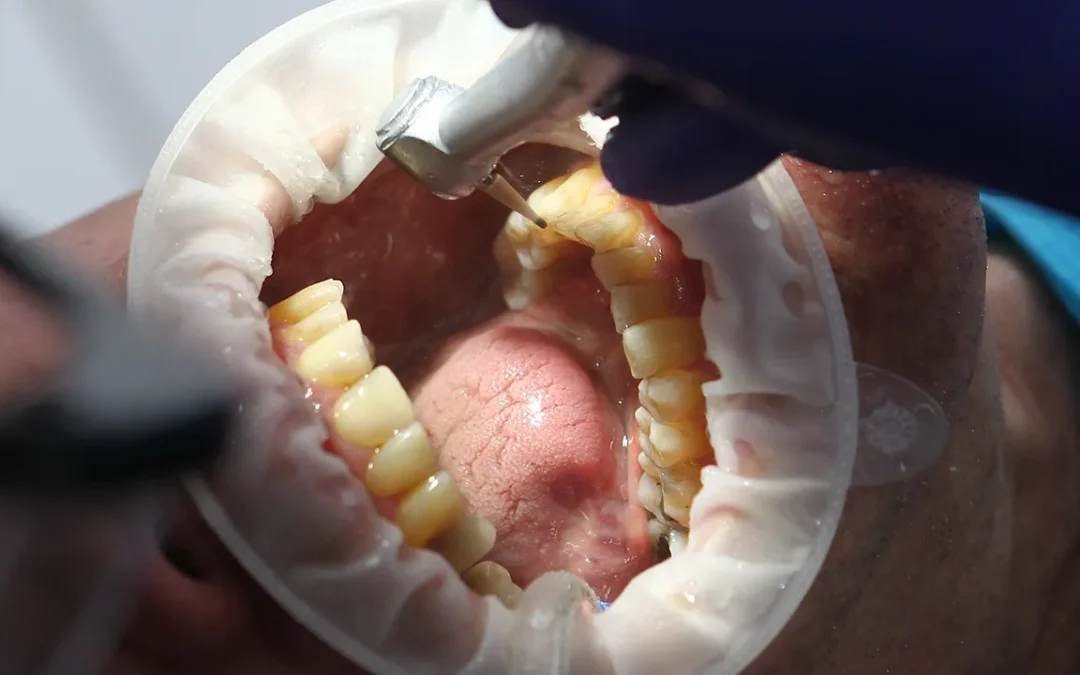 What Does a Cavity Look Like? Early Warning Signs