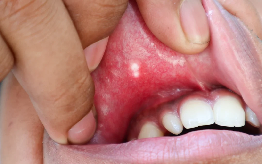 Canker Sores: Why They Happen and How to Get Rid of Them