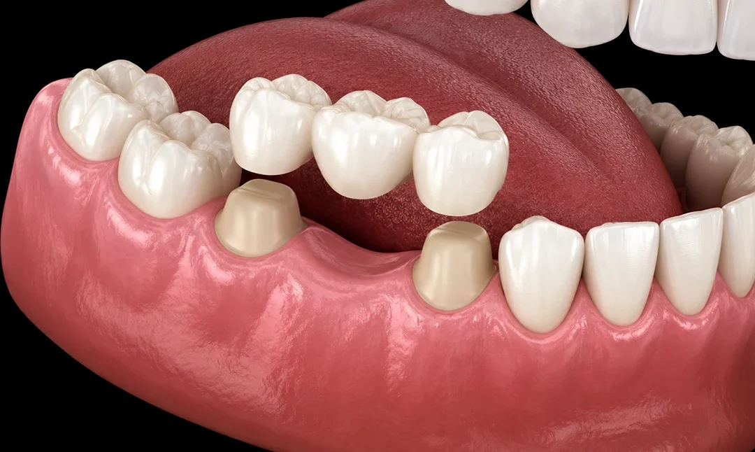 Replacing Missing Teeth With Dental Bridges